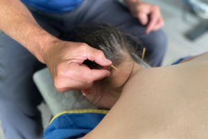 How Dry Needling Can Help Relieve Chronic Headaches and Migraines